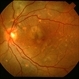 Central Serous Chorioretinopathy 2
